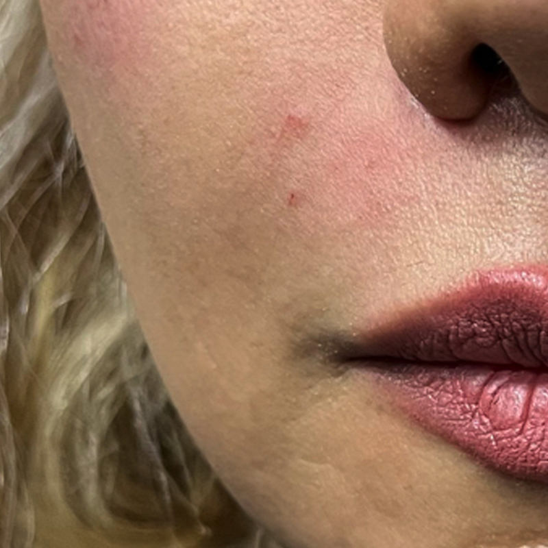 تزریق یک سی سی فیلر خط خنده